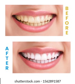 A woman's Teeth Before and After Teeth Whitening. Happy smiling woman. Dental health Concept. Oral Care concept