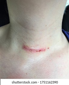 Womans Thyroidectomy Scar After Having Stitches Stock Photo 1751162390 ...