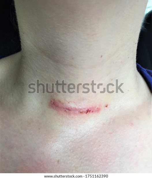 Womans Thyroidectomy Scar After Having Stitches Stock Photo 1751162390 ...