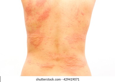 荨麻疹图片 库存照片和矢量图 Shutterstock