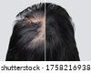 black alopecia