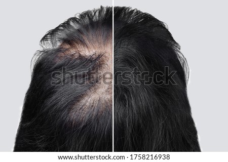 Women baldness alopecia. Hair after using cosmetic powder to thicken hair. Before and after.