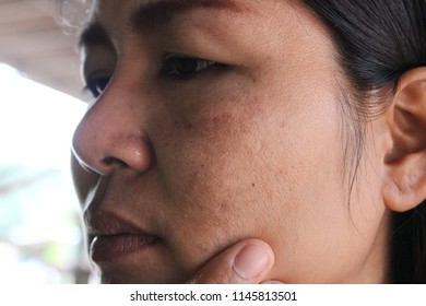 Women With Dull Skin Problems