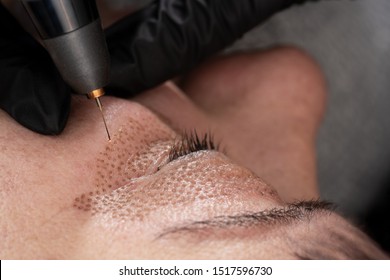 Women Eyelid Lifting, Fibroblast Procedure.