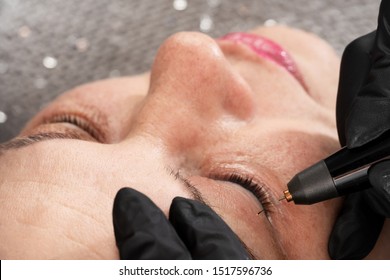 Women Eyelid Lifting, Fibroblast Procedure.