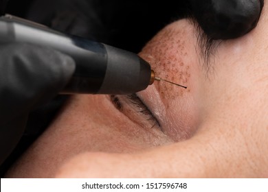 Women Eyelid Lifting, Fibroblast Procedure.