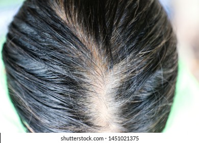 Hair Loss Black Woman Images Stock Photos Vectors Shutterstock