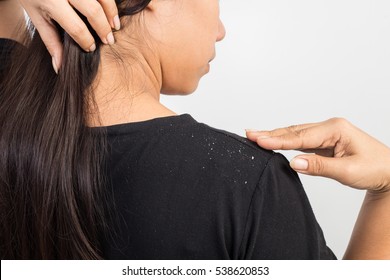 Women Having Dandruff In The Hair And Shoulder