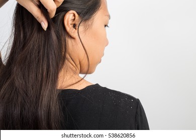 Women Having Dandruff In The Hair And Shoulder