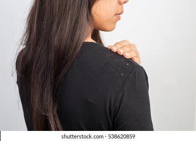 Women Having Dandruff In The Hair And Shoulder