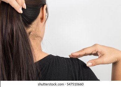 Women Having Dandruff In The Hair And Shoulder