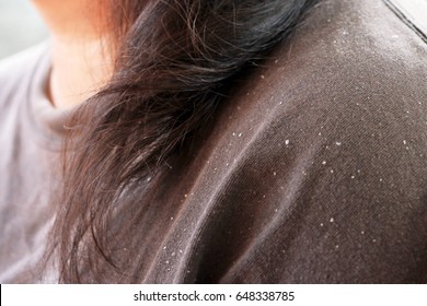 Women Having Dandruff In The Hair And Shoulder