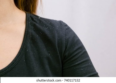 Women Having Dandruff In The Hair And Shoulder. Women Have Itchy Scalp Fungus. Dander That Causes Itching Scalp