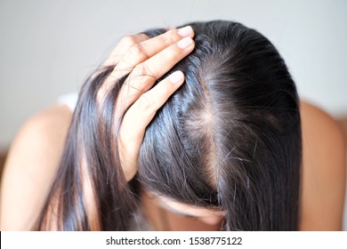 Women head with dandruff caused by the problem of dirty.
