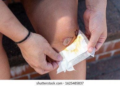 Women Knee Scrape And Showing Wound Under Bandage