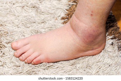 Hematoma Images, Stock Photos & Vectors | Shutterstock