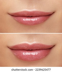 Women lips correction before and after comparison. Hyaluronic acid injection. Beauty lip treatment procedure. 