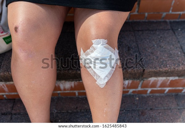 women scrape knee\
and showing wound bandage