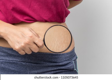 Women Show off the belly after birth. Stretch Marks on white background - Shutterstock ID 1105073645