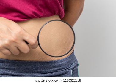 Women Show off the belly after birth. Stretch Marks on white background - Shutterstock ID 1166322358
