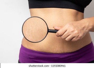 Women Show off the belly after birth. Stretch Marks on white background - Shutterstock ID 1192080961