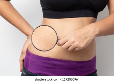 Women Show off the belly after birth. Stretch Marks on white background