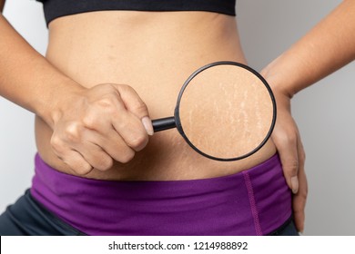 Women Show off the belly after birth. Stretch Marks on white background