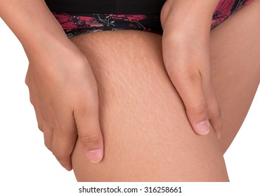 Women With Stretch Marks Of Skin On The Thigh 