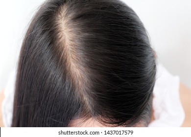 What Causes Hair Loss Images Stock Photos Vectors Shutterstock