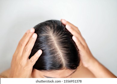 Women with thin hair caused by hair loss sympoms.
