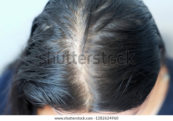 Women Thin Hair Caused By Hair Stock Photo Edit Now 1282624960