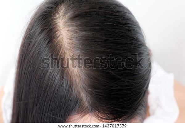 Women Thin Hair Caused By Hair Stock Photo Edit Now 1437017579