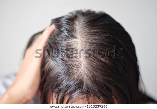 Women Thin Hair Caused By Hair Stock Photo Edit Now 1510239266