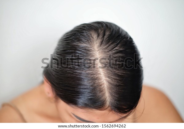 Women Thin Hair Caused By Hair Stock Photo Edit Now 1562694262