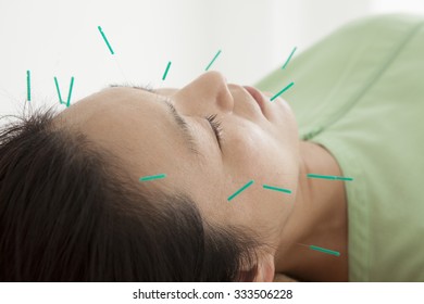 Women Undergoing Acupuncture To Face