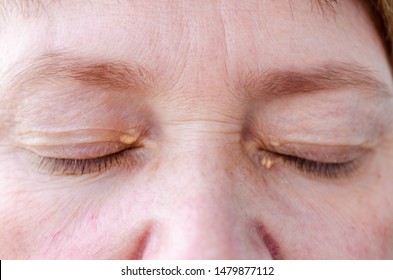 Womens Eyelids With Small Growths Due To Disorders Of Lipid Metabolism. Medical And Cosmetology Problem