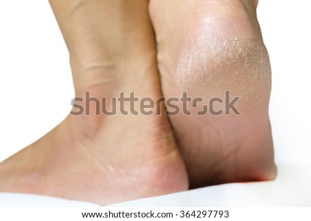 Women's feet dry On a white background