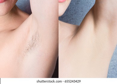 women's underarm hair removal before after concept