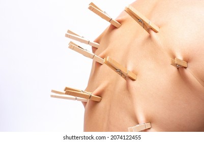 Wooden Clothespin On Skin Man's Back Pain Ache Discomfort Resentment