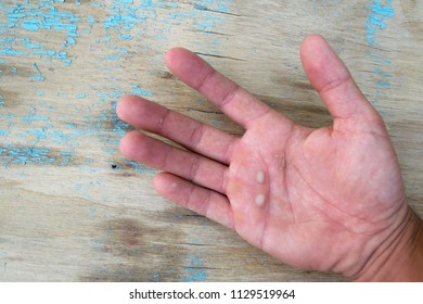 The Working Hands, Corns