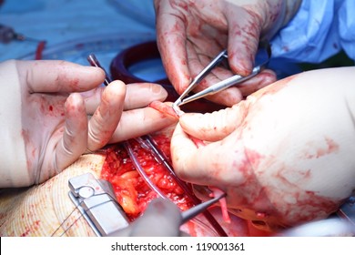 Working With The Vein. Coronary Artery Bypass Surgery. Cardiac Surgery.