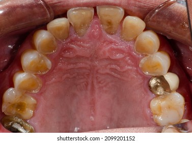 The worn down nearly exposed pulp teeth and a gold dental crown