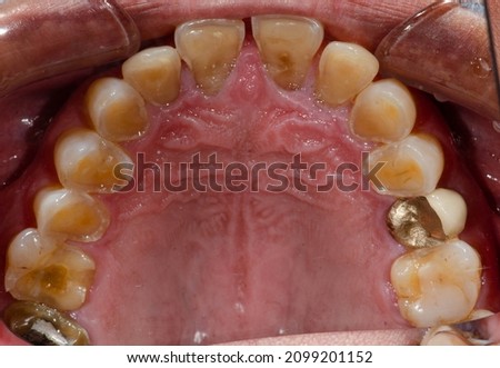 The worn down nearly exposed pulp teeth and a gold dental crown