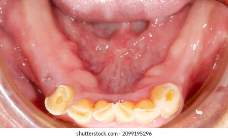 the worn lower front teeth and missing teeth because of hard biting and bruxism