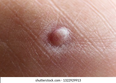 bee sting infection bee sting infection