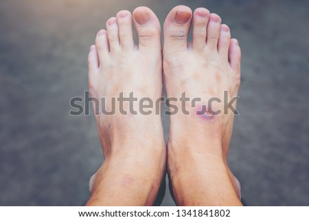 wound of beginning diabetic foot compare with normal foot.