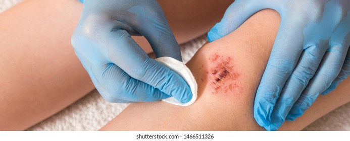 wound with blood on the knee of the leg and the doctor treats with medicine