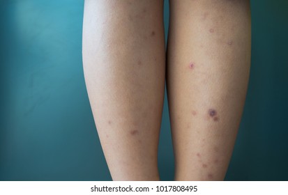 Dark Spots On Legs High Res Stock Images Shutterstock