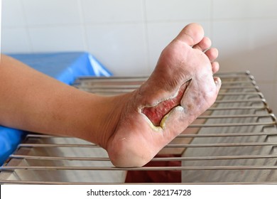 wound of diabetic foot 