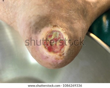 Wound with diabetic foot disease and gangrene foot and pressure sore and bed. Medical and healthcare concept.
